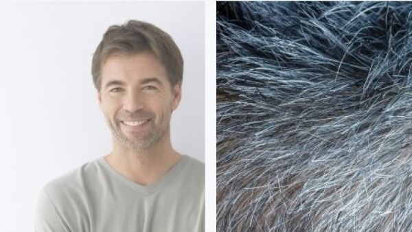 Mannen grijpen steeds sneller naar haartransplantatie