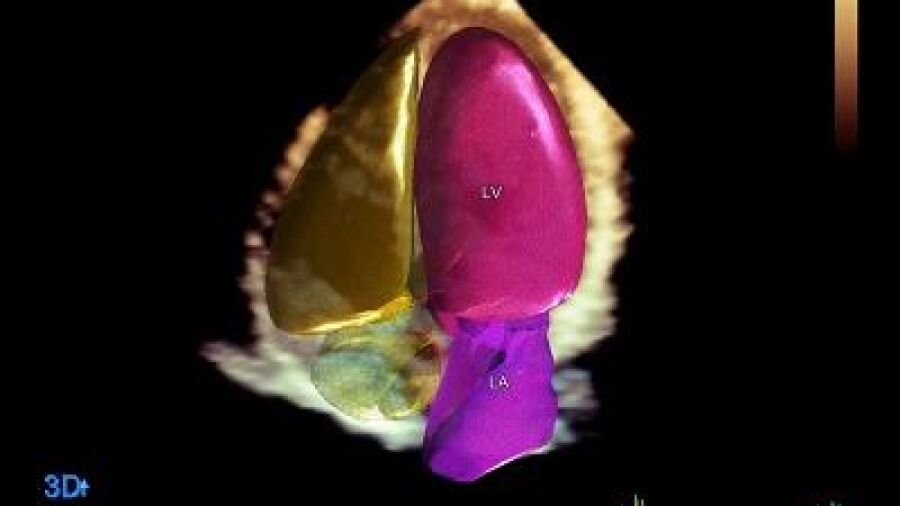 Philips presenteert HeartModel