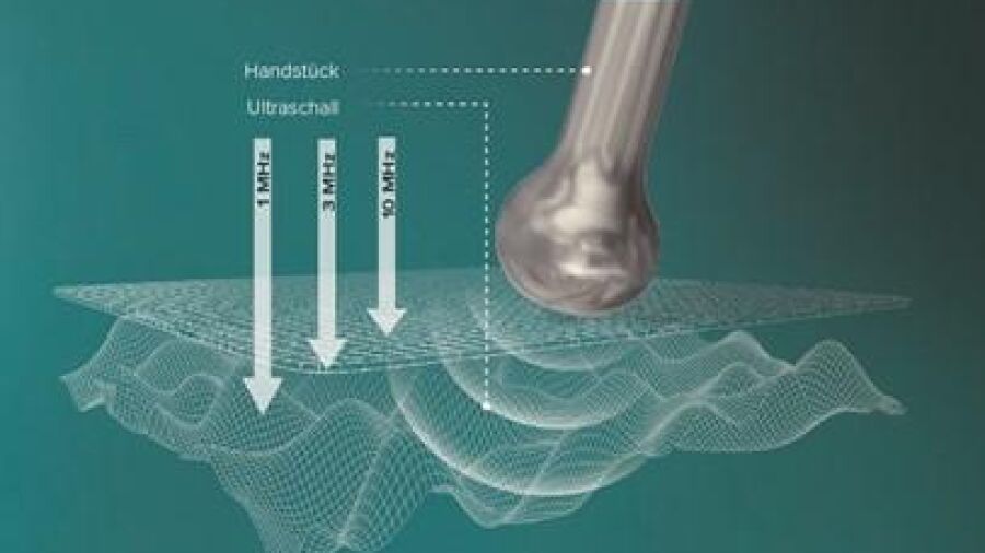 Ultrasone golven tegen rimpels, een onzuivere of gevoelige huid, littekens, striae en cellulitus