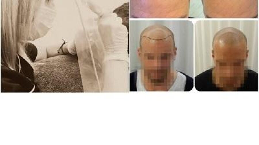 De Tricopigmentatie Micro Haarpigmentatie-methode,  betaalbaar alternatief voor haartransplantatie